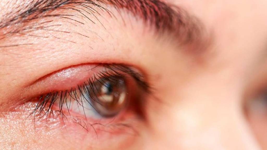 Nem sempre é cansaço: 8 motivos por trás das pálpebras inchadas