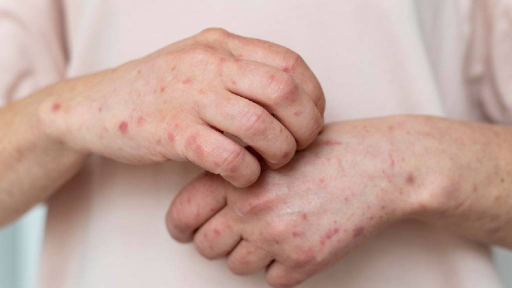 Mpox: especialistas explicam sintomas, tratamento e riscos